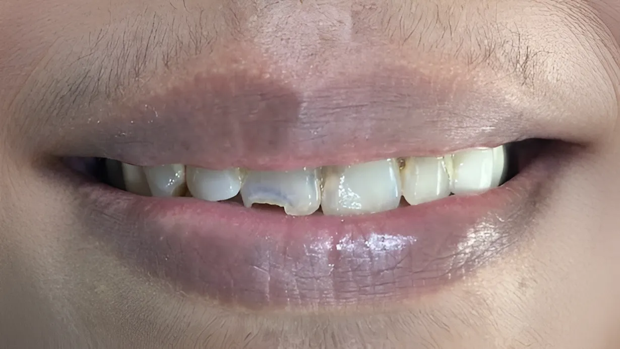 Clear Aligner Diastema & Alignment Correction Before