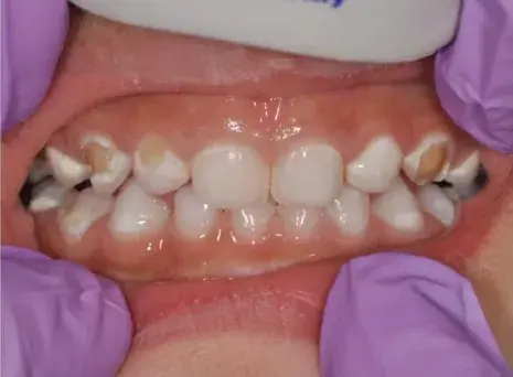 Pediatric Gentle Caries Restoration Before